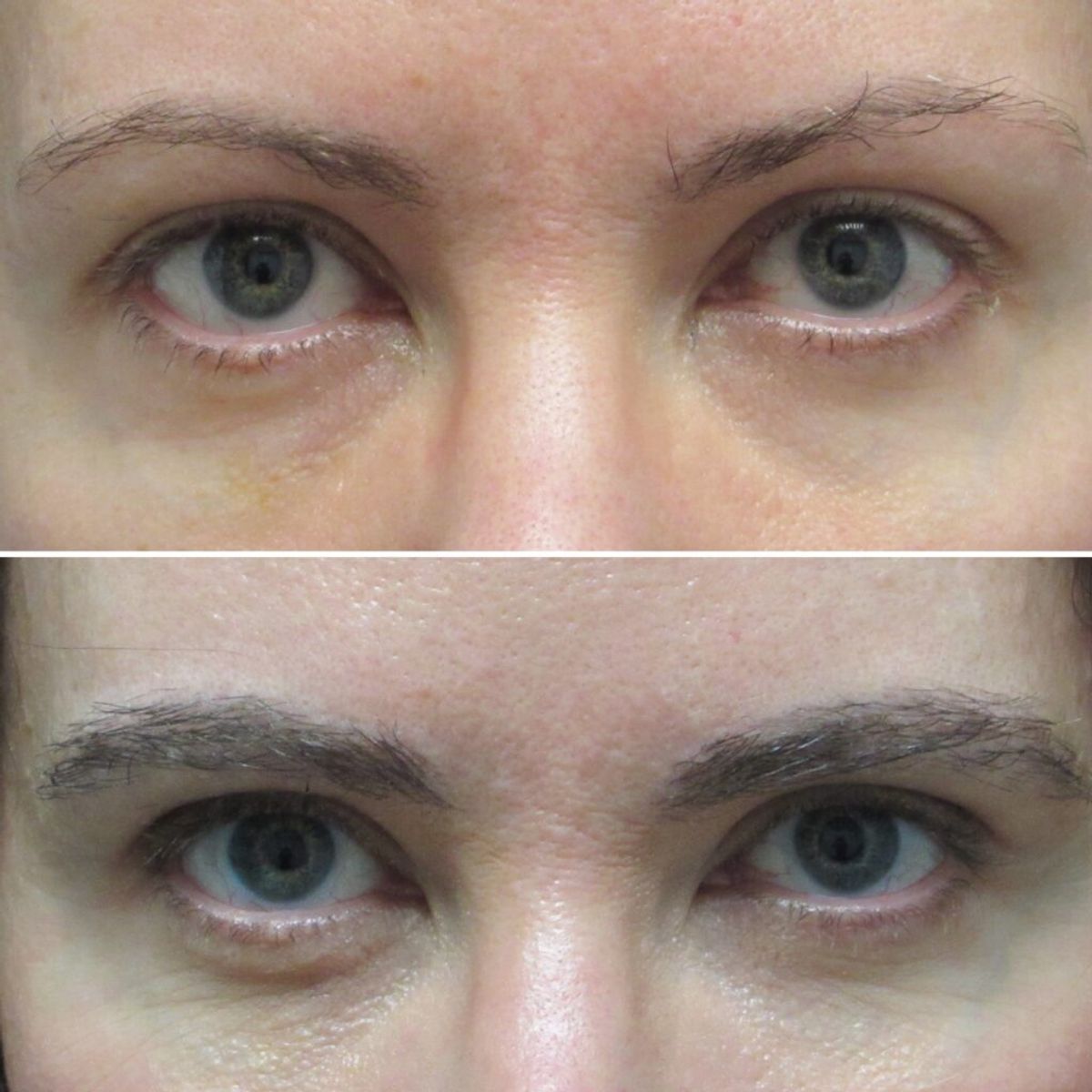 NewBeauty’s Real Patient Stories, Eyebrow Transplant