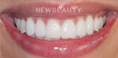 Dr. Victoria Veytsman - Smile Makeover - After