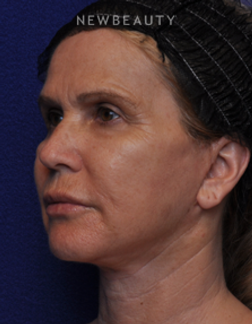 Dr. Alan J. Durkin - Facelift - After