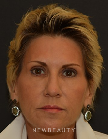 Dr. Janet Allenby - Dysport - After