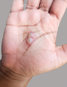 Dr. Anna Chacon – Hand Dermatitis - 34277661 - Before