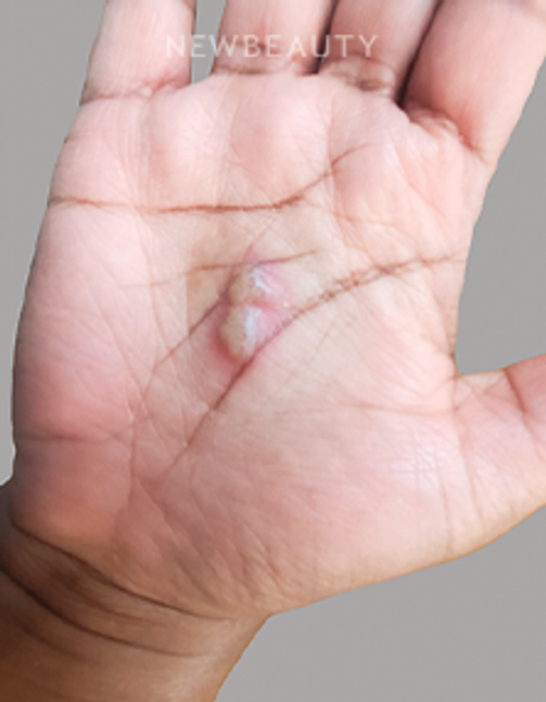 Dr. Anna Chacon – Hand Dermatitis - 34277661 - Before