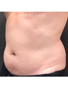 Dr. Janet Allenby - CoolSculpting - Before