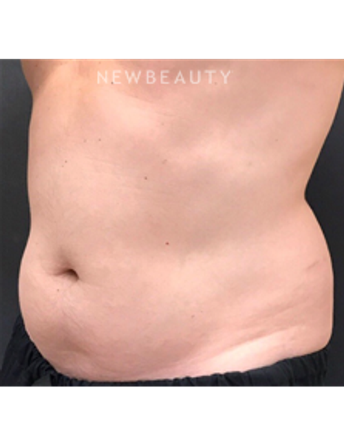Dr. Janet Allenby - CoolSculpting - Before