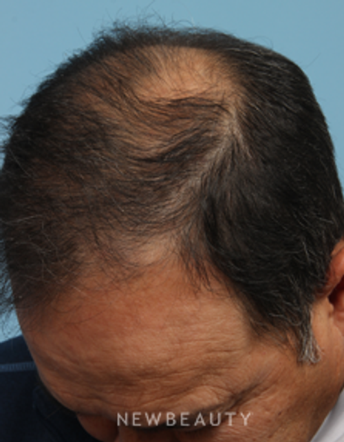Dr. Kathleen Behr - Hair Loss Treatment - After