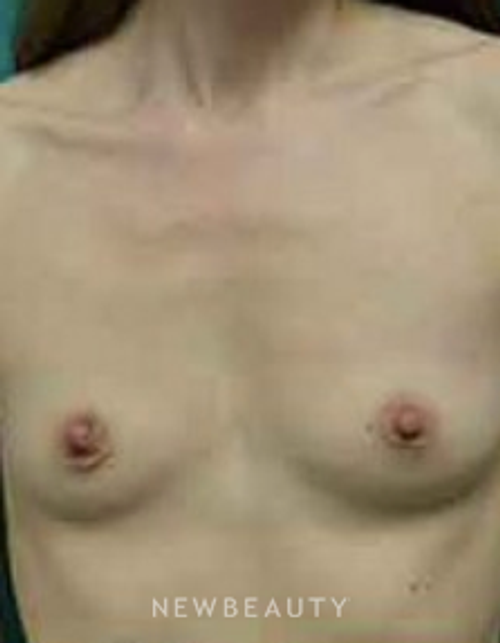 Dr. Aviva Preminger - Breast Implants - Before