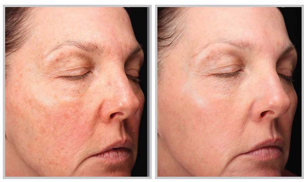 Patient shown one month after one Halo Tribid treatment.