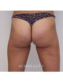 Dr. Julia Russak- Cellulite Treatment - After