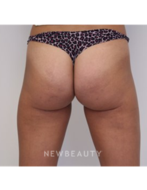 Dr. Julia Russak- Cellulite Treatment - After