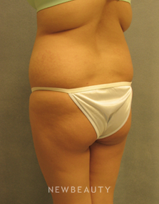 Dr Sean Simon Butt Augmentation - Before