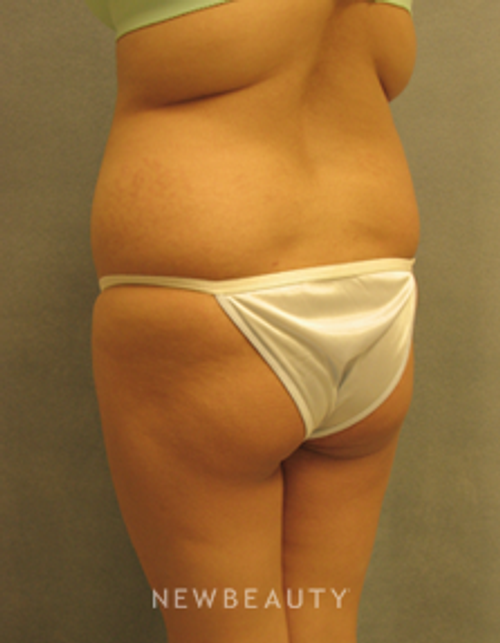 Dr Sean Simon Butt Augmentation - Before