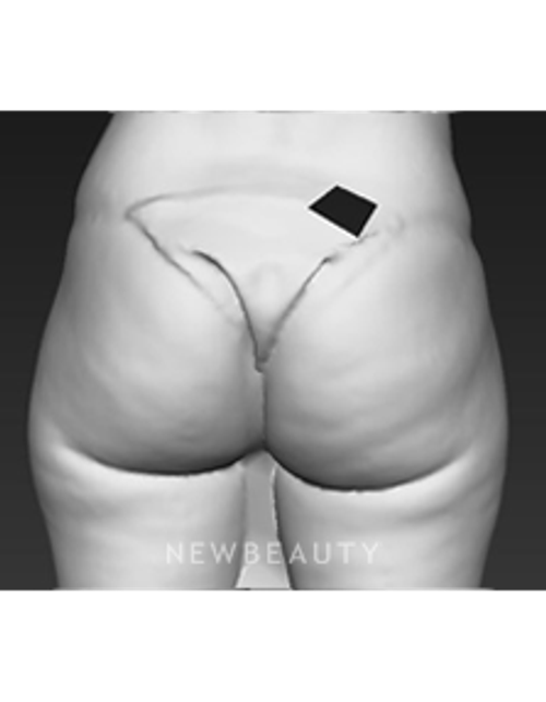 Dr. Brad Bengtson - Cellulite Treatment - After