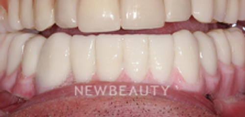 Dr. Hamid Atabakhsh - Dental Implants - 46426474 - After