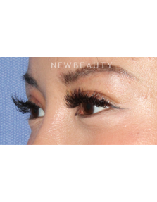 Dr. Lily Lee - Asian Eyelid Revision Surgery - After