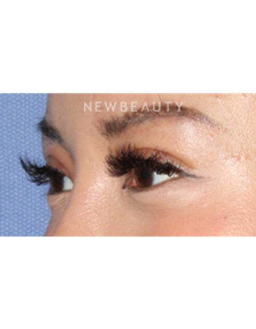 Dr. Lily Lee - Asian Eyelid Revision Surgery - After