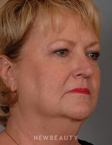 Dr. Henry Mentz Facelift, Eye Lift, Neck Lift, Lasers - Before