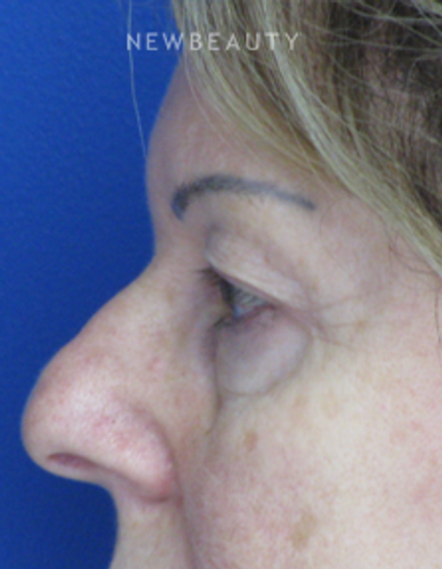 Dr. Joseph Russo - Refreshed and Restored (Eye EBG) - Before