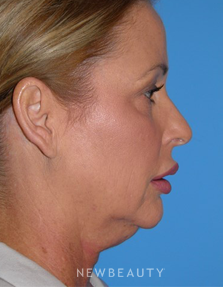 Dr. George Sanders - Necklift - Before