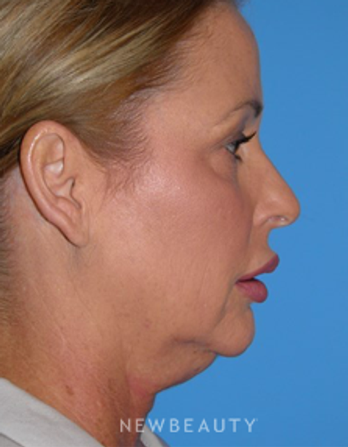 Dr. George Sanders - Necklift - Before