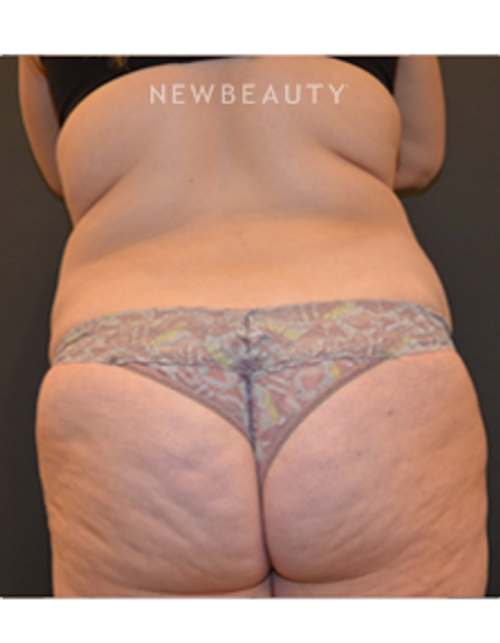 Dr. Aviva Preminger - CoolSculpting - Before