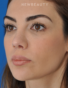 Dr. Edward Kwak - Revision Rhinoplasty - After