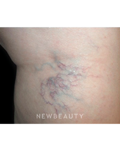 Dr. Marina Peredo - Vein Treatment - Before