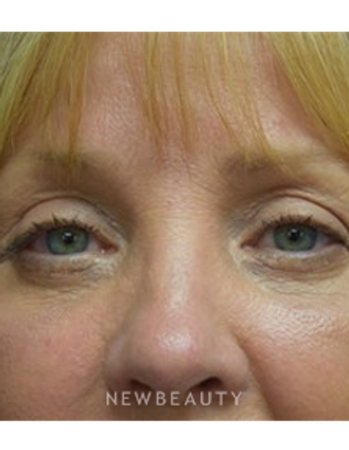 Dr. Jeffrey B. Wise - Eyelift - After