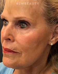 Dr. Janet Allenby - ThermiTight - After