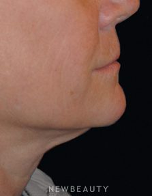 Dr. Lee Ann Klausner Ulthera Skin Tightener - After