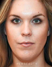 Dr. Janet Allenby - Nonsurgical Facial Contouring - After