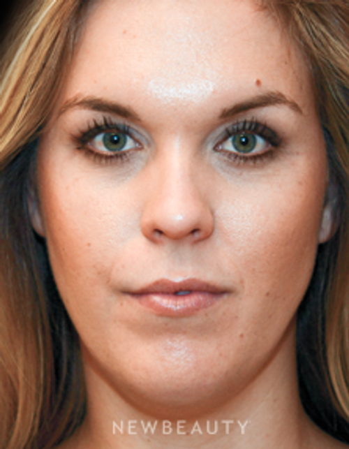 Dr. Janet Allenby - Nonsurgical Facial Contouring - After