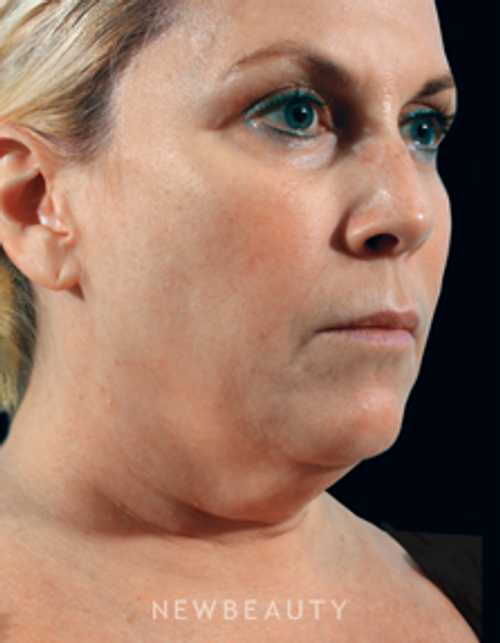 Dr. Marina Peredo Ulthera - Before
