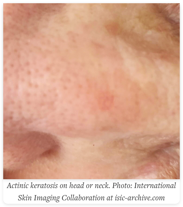 actinic keratosis on head or neck