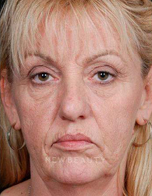 Dr. Steven Bloch Eyelid Lift, Face Lift, Fat Transfer - Before