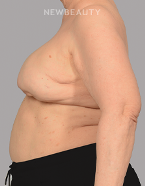 Dr. Mahabir - Breast Reconstruction - 20637718 - Before