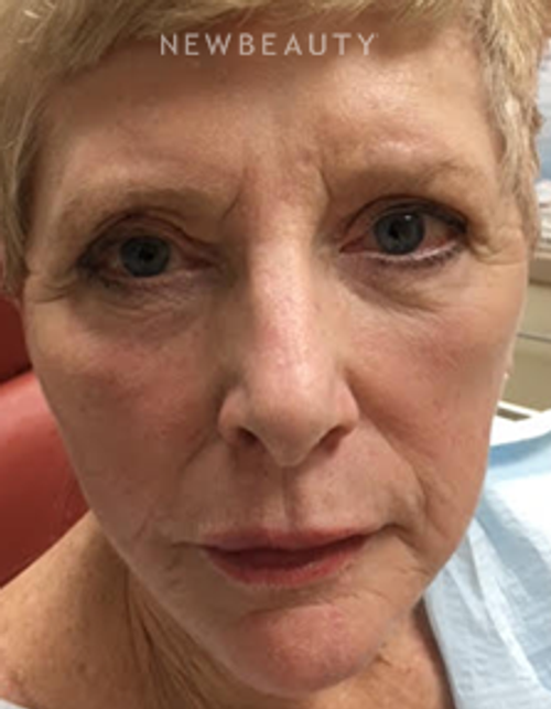 Dr. Mokhtar Asaadi - Facelift - After