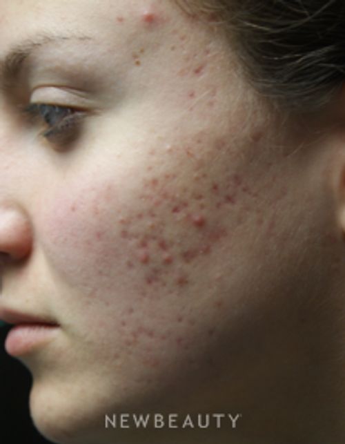 Dr. Marina Peredo Injections/Liquid Lift - Before