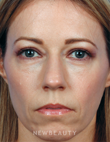 Dr. Kelly Bomer - Upper Blepharoplasty - After