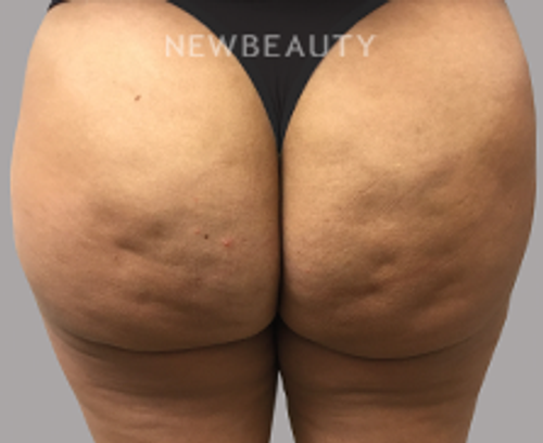 Drs. Elias - Cellulite Treatment - 17150176 - Before
