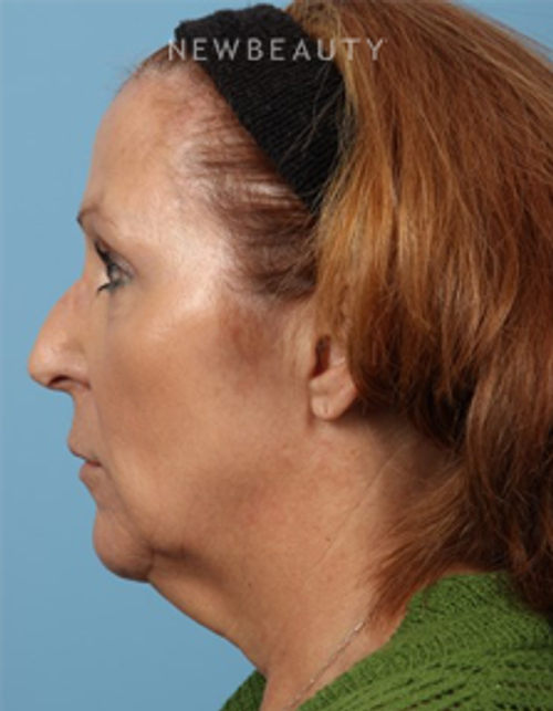 Dr. Carmen Kavali- Liquid Facelift - Before