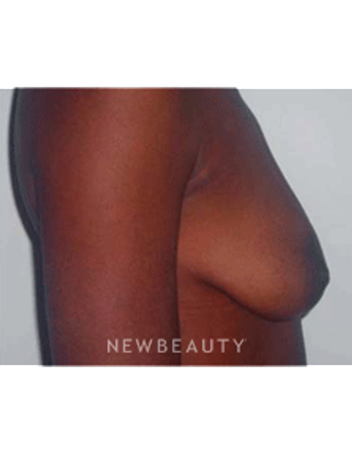 Dr. Michael Horn Breast Lift - Before