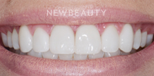 Dr. Nathan Hoffman - Teeth Whitening & Veneers - After
