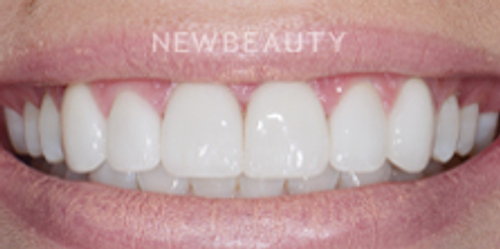 Dr. Nathan Hoffman - Teeth Whitening & Veneers - After