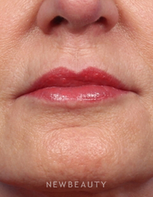 Dr. Kelly Bomer – Lip Filler - After