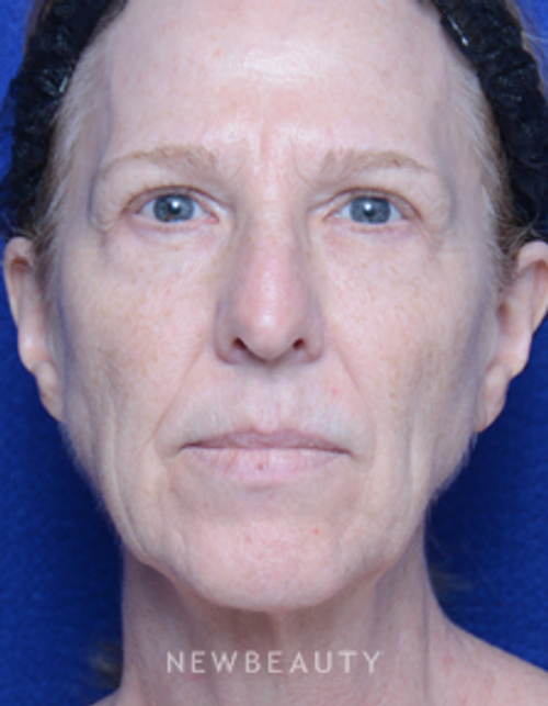 Dr. Alan Durkin - Facelift - Before