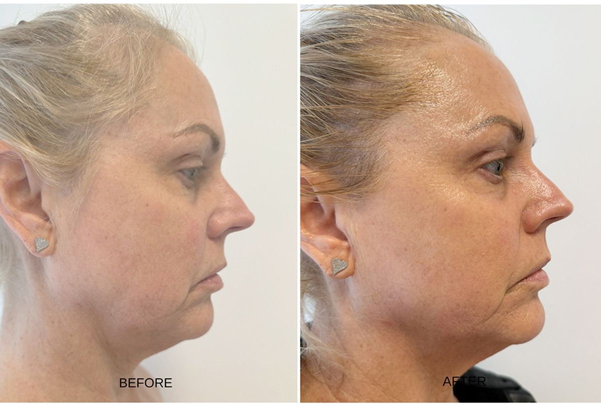 SKORR GLOW BEORE AND AFTER