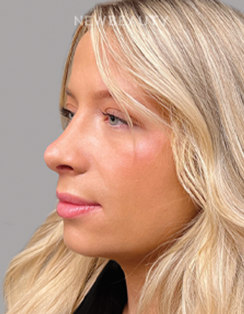 Dr. Salvator J. La Mastra - Smile Enhancement - 44409759 - Before