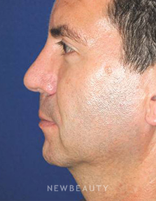 Dr. Lee Ann M. Klausner - Revision Rhinoplasty - After