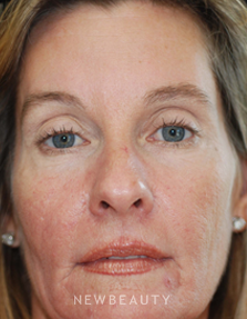 Dr. Kenneth Beer Injectables & Fillers, IPL Lasers - After