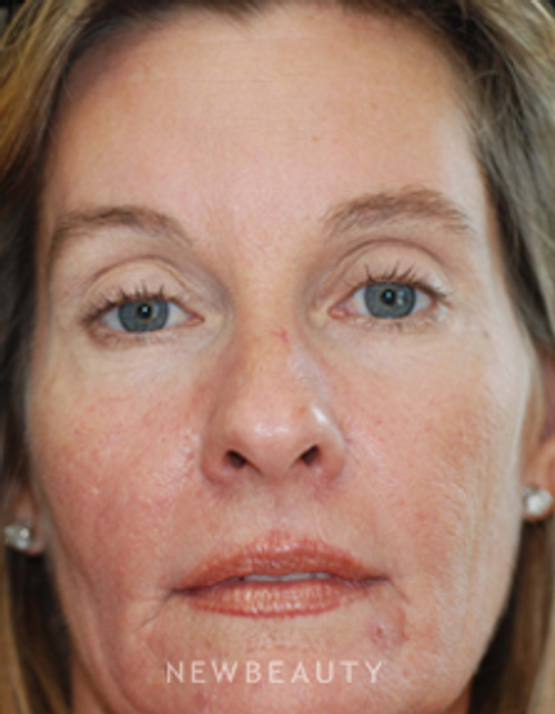 Dr. Kenneth Beer Injectables & Fillers, IPL Lasers - After
